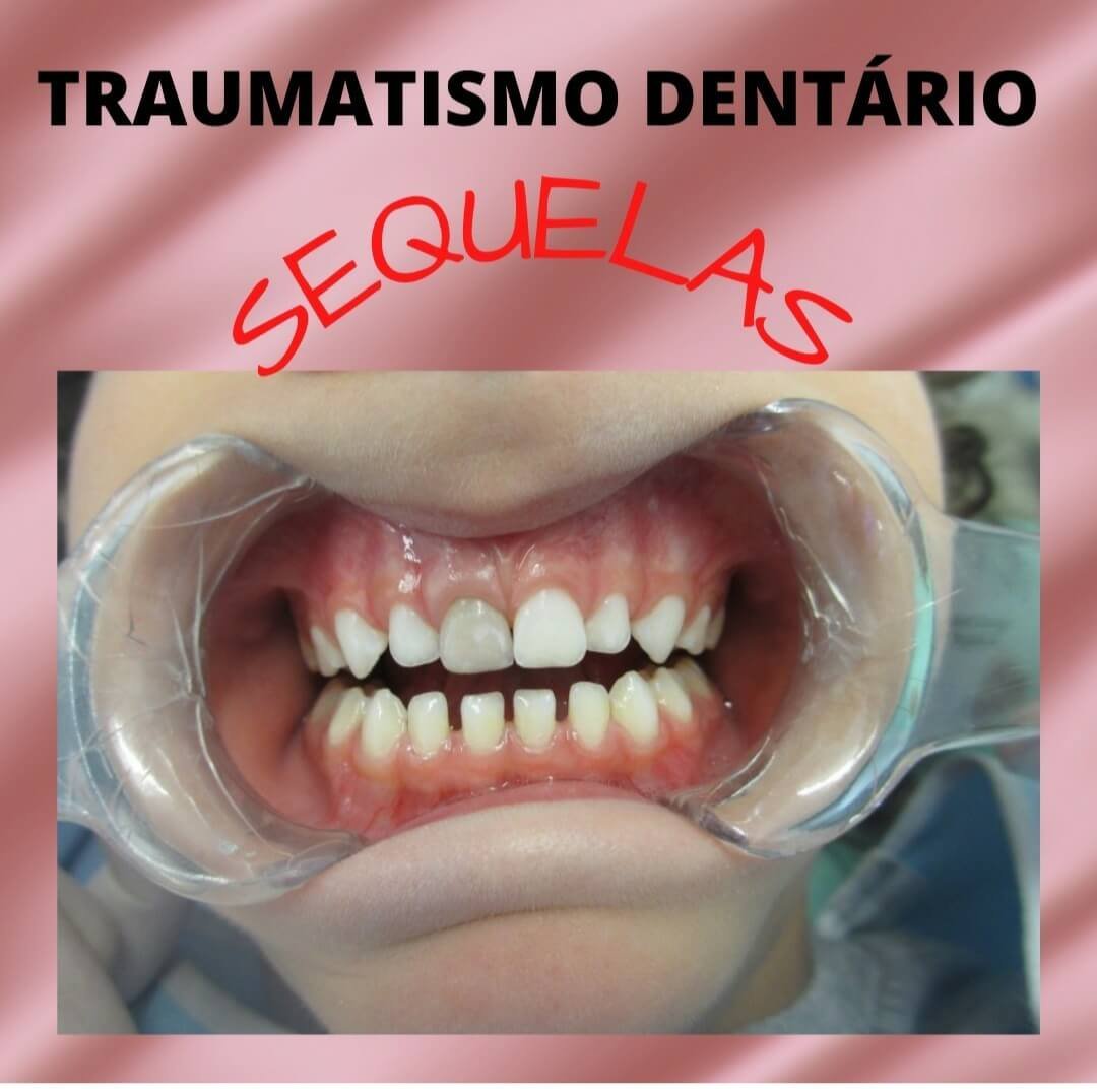 Traumatismo Dentário - Marlon Câmara Lopes