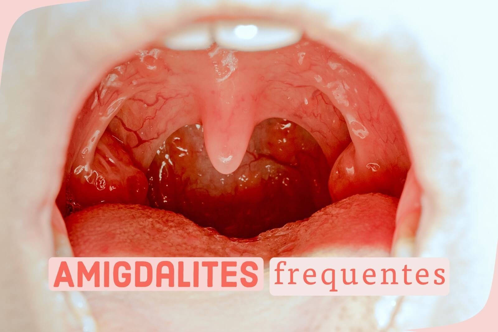 Amigdalites frequentes - Marlon Câmara Lopes