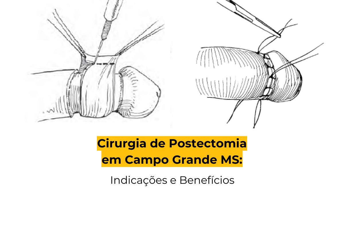 Cirurgia de Postectomia em Campo Grande MS: Indicações e Benefícios -  Marlon Câmara Lopes